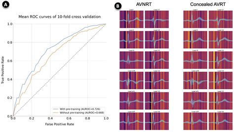 PO 05 229 DEEP LEARNING CLASSIFICATION OF PAROXYSMAL SUPRAVENTRICULAR