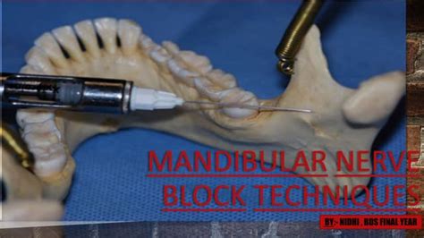 Mandibular Nerve Block Techniques Ppt