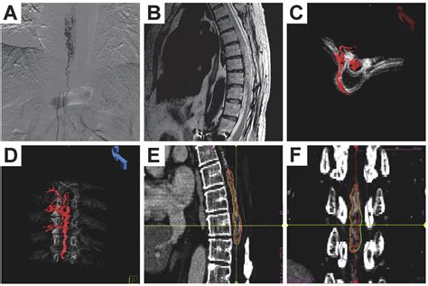 Stereotactic Radiosurgery For Intramedullary Spinal Arteriovenous Malformations Journal Of