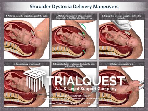 Shoulder Dystocia Delivery Maneuvers Illustration Trialquest In