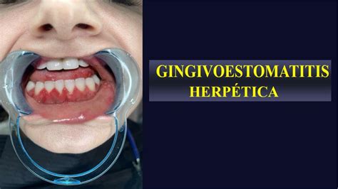 Gingivoestomatitis Herpetica Odalys Del Valle Pino De Moreno UDocz