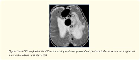 Figure 1 From Transvenous Endovascular Embolisation Of Nongalenic