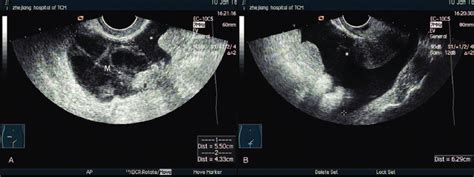 (A) Sagittal ultrasound image showing the complex adnexal mass (M ...