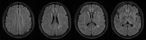 Prevalence Of White Matter Hyperintensity In Young Clinical Patients Ajr