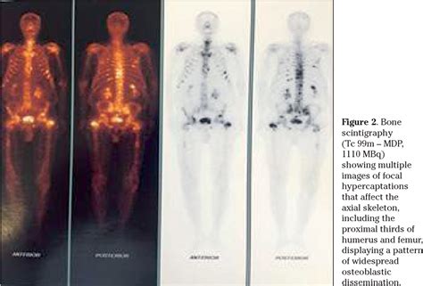 Figure 1 from NOTAS CLÍNICAS0 Infiltrating gastric adenocarcinoma with