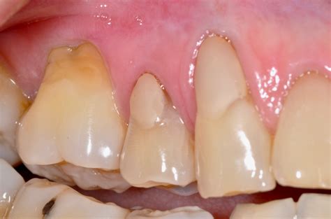 Exposed tooth roots: The “root” of tooth sensitivity in aging – Alamo ...