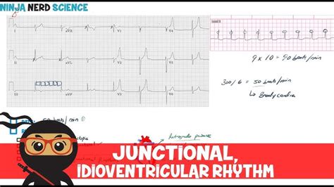 Junctional Bradycardia Rhythm Strip