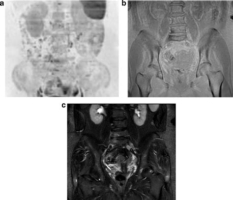 Evaluation Of Diffuse Bone Marrow Infiltration Pattern In Monoclonal