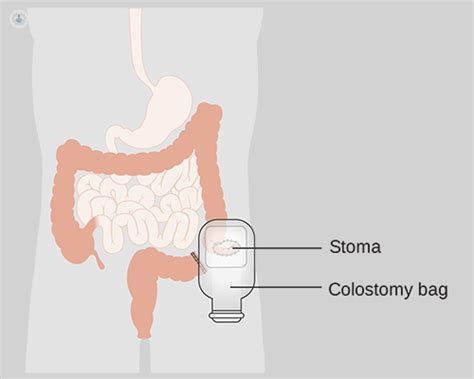 How Long Can You Live With A Permanent Colostomy Bag Macy Paredes