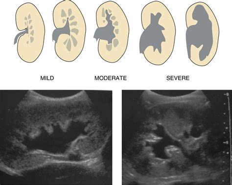 Mild Hydronephrosis Ultrasound