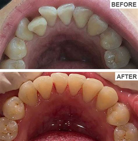 Before And After Dental Treatment Smileon Pk