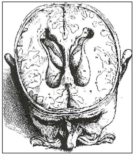 4 Représentation des ventricules cérébraux du cerveau humain à