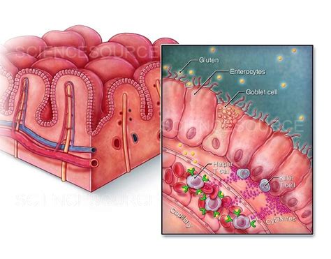 Villi Small Intestine Celiac Disease