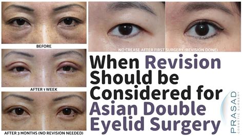 Facelift Surgery And Eyelid Surgery By Dr Amiya Prasad New York