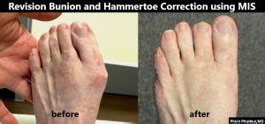 Minimally Invasive Hammertoe Correction CNOS