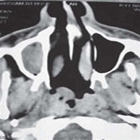 Endoscopic Photograph Showing A Fungus Ball In The Left Sphenoid Sinus