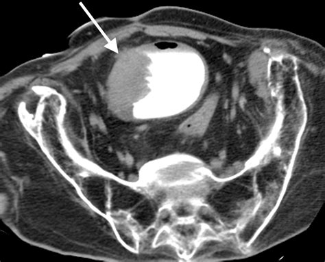 Bladder Squamous Cell Carcinoma Radiographics