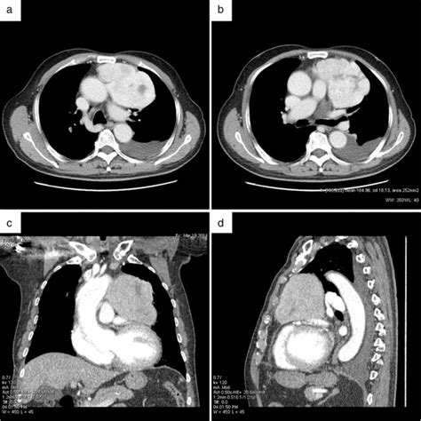 Chest Computed Tomography CT Scan Showed Multiple Recurrences A B