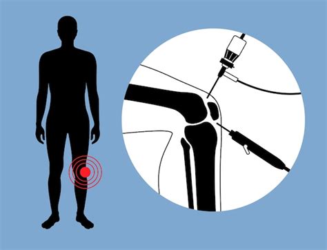 Arthroscopie De Larticulation Du Genou Vecteur Premium