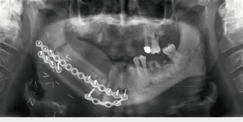 Double Barrel Fibula Free Flap Source Kokosis Et Al Image