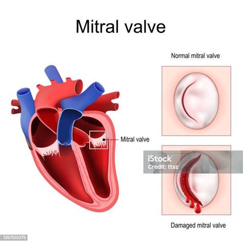 Anatomi Jantung Katup Mitral Ilustrasi Stok - Unduh Gambar Sekarang - Mitral Valve, Jantung ...