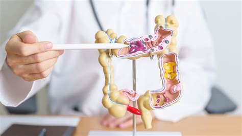 ibd specialists   ibd doctors ulcerative colitis treatment