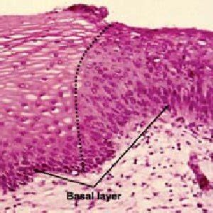 Criteria (features) of the Epithelial Dysplasia as mentioned from [11] | Download Scientific Diagram