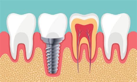 Implant nha khoa là gì Đối tượng nên sử dụng và chi phí