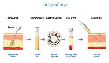 Autologous Fat Transfer and Fat Grafting in Mount Vernon WA