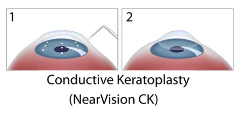 LASIK Las Vegas | Conductive Keratoplasty | Shepherd Eye