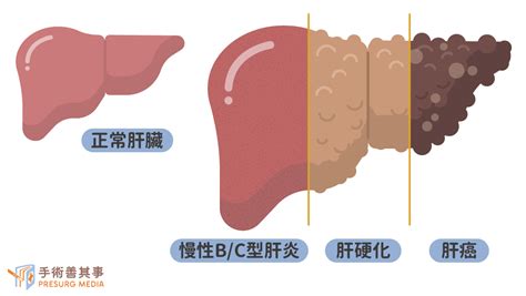 肝癌早期症狀有哪些？存活率、原因、診斷與治療方式