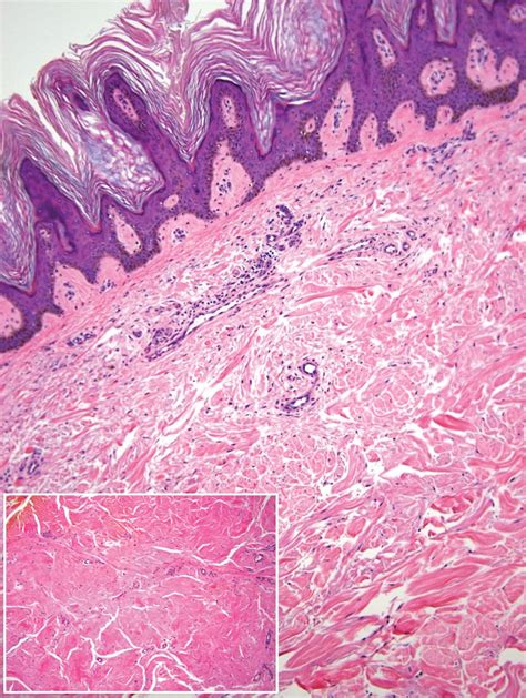 Cutaneous Insulin Derived Amyloidosis Presenting As Hyperkeratotic