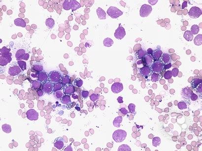 Burkitt lymphoma-leukemic phase