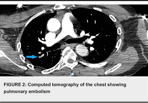 Figure 2 From A Case Of Severe Psychosis Due To Cushing S Syndrome Secondary To Primary