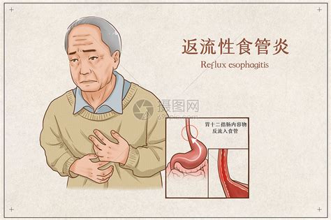 反流性食管炎医疗插画插画图片下载 正版图片401804083 摄图网