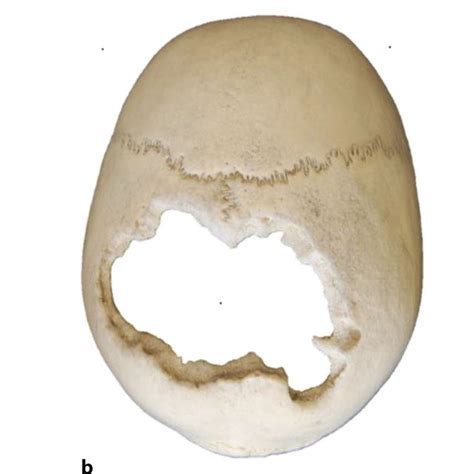 A C Examples Of Tertiary Syphilis A Frontal Bone Showing Concave