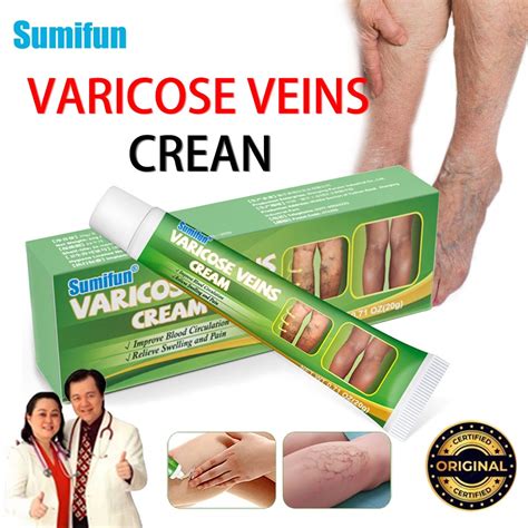 Varicose Vein Remover Cream Original Spider Vein Pain Varicosity