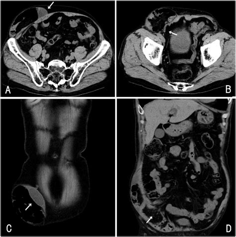 Computed Tomography Ct Scan Findings A The Hernia Sac Extends To