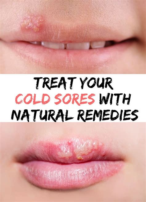 Treat Your Cold Sores With Natural Remedies Restore Your Beauty And