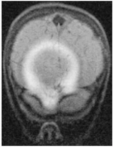 Artifacts In Mri Radiology Key