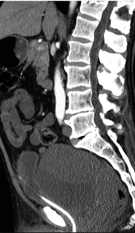 Sagittal Reconstruction Ct Scan After Contrast Administration The Download Scientific Diagram