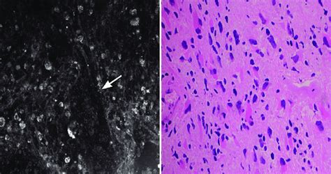 Confocal Reflectance Microscopy Image Of A Glioblastoma On The Left