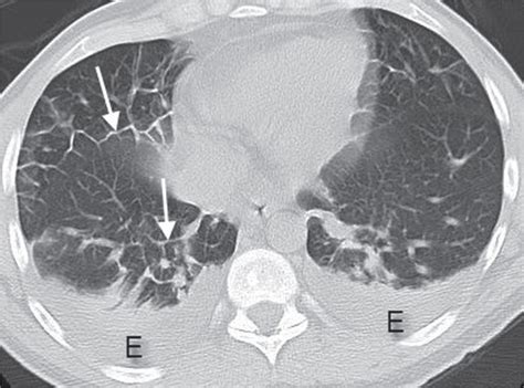 Interstitial Lung Disease Radiology Key