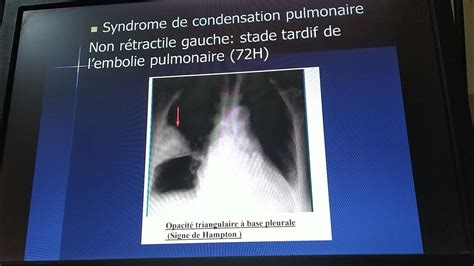 Sémiologie Cardiaque Et Respiratoire Révision 1 Cas Cliniques Examen