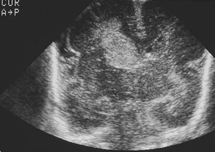 Germinal Matrix Hemorrhage Grade 1