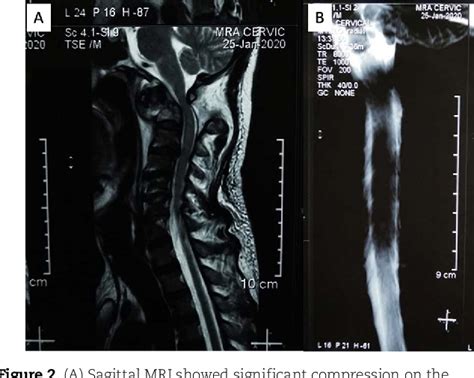 Figure 1 From Severe Traumatic Atlantoaxial Dislocation And Type III