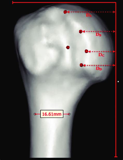 Posteroanterior View Of 3 Dimensional Left Humerus With Medialization Download Scientific