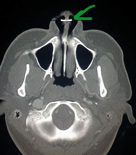 207 best images about CT Scans on Pinterest | Cars, Gallstone and ...