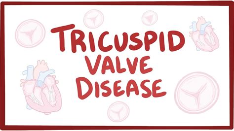 Tricuspid valve disease: Video, Causes, & Meaning | Osmosis