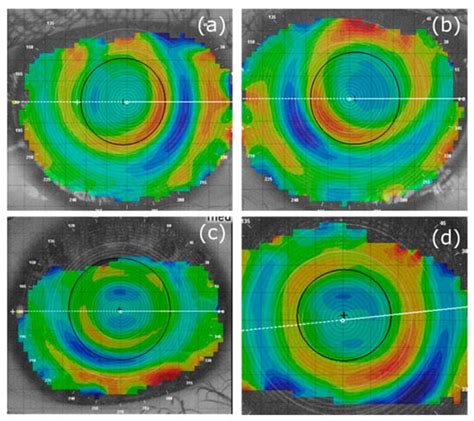 Jcm Free Full Text Multifocal Orthokeratology Versus Conventional Orthokeratology For Myopia